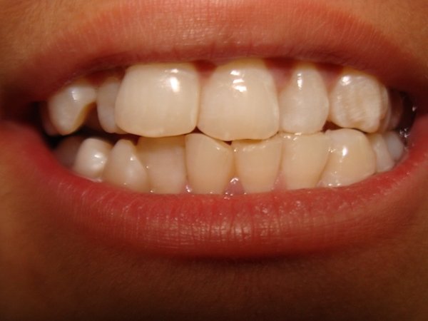 boy hidden teeth removed 