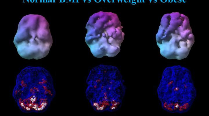 Brain Scans Obesity