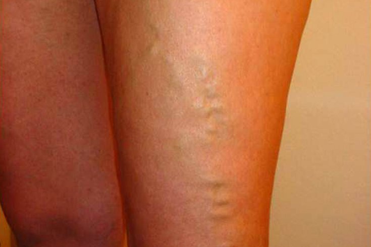 Everything you need to know about varicose veins