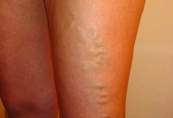 Varicose Veins Wiki 08122019