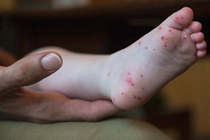 hand-foot-and-mouth-disease-is-on-the-rise-phillyvoice