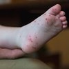 08132018_hand-foot-mouth_disease_CDC