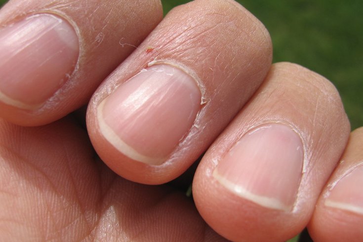 On fingernails indents small Dents in