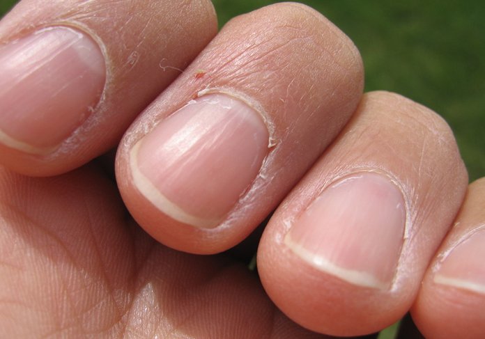 Dents my nails have Why do