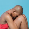 alopecia hair loss