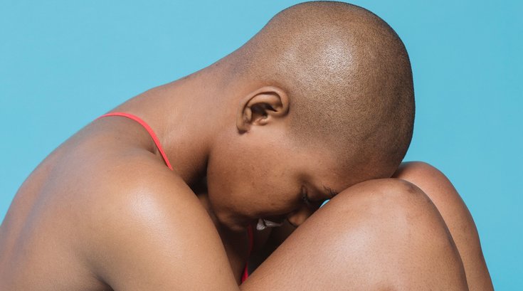 alopecia hair loss