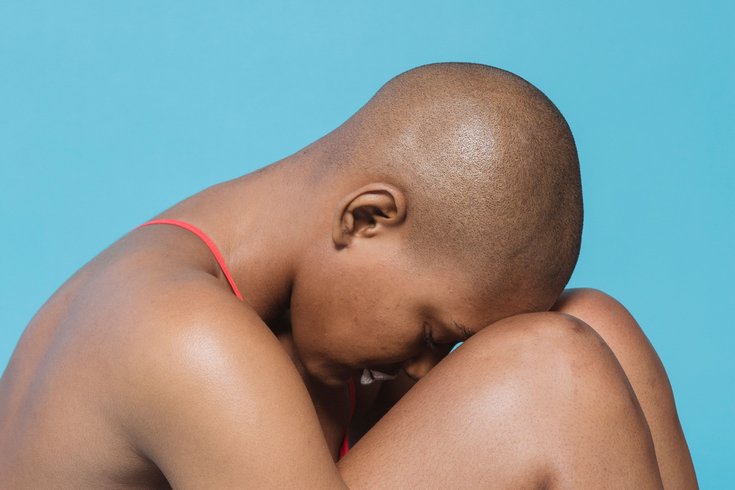 alopecia hair loss