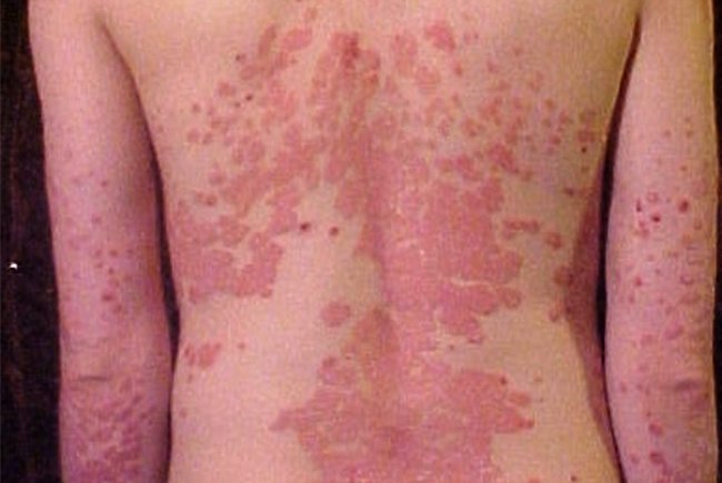 08302018_psoriasis_Wikipedia