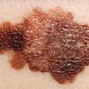 Melanoma At Home Test
