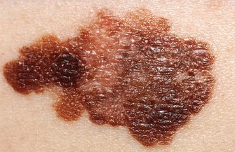 Melanoma At Home Test