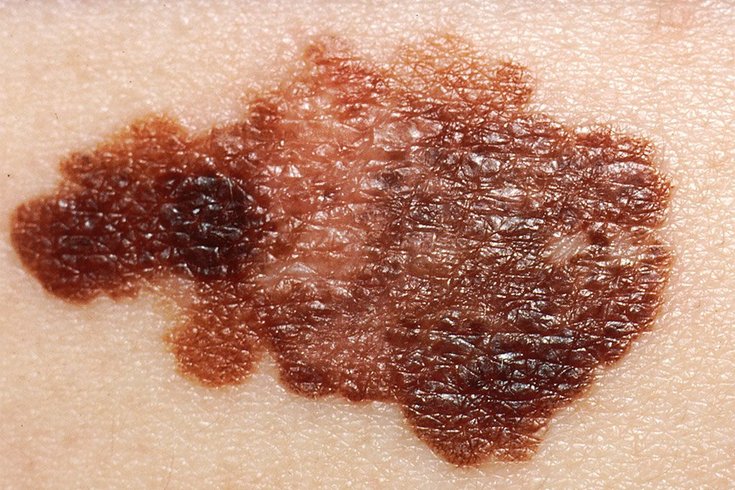 Melanoma At Home Test