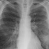 Lungs Pneumonia 09112019