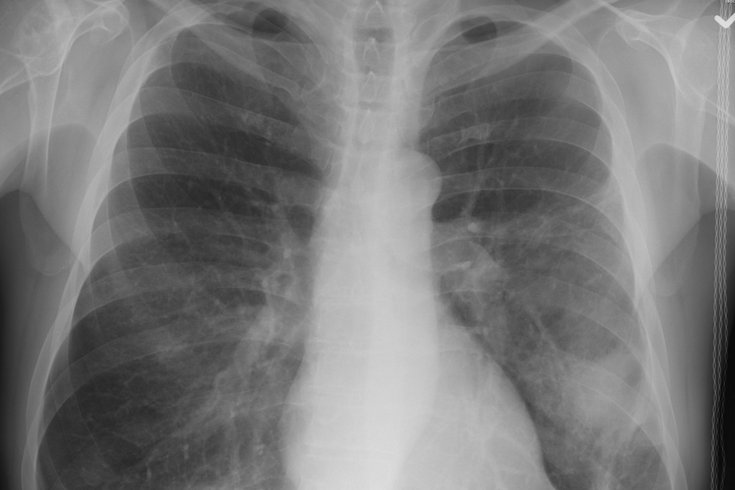 Lungs Pneumonia 09112019