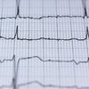 Heart Failure EKG