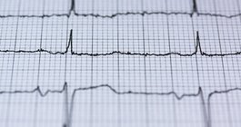 Heart Failure EKG