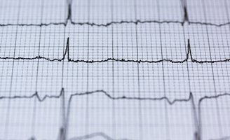 Heart Failure EKG