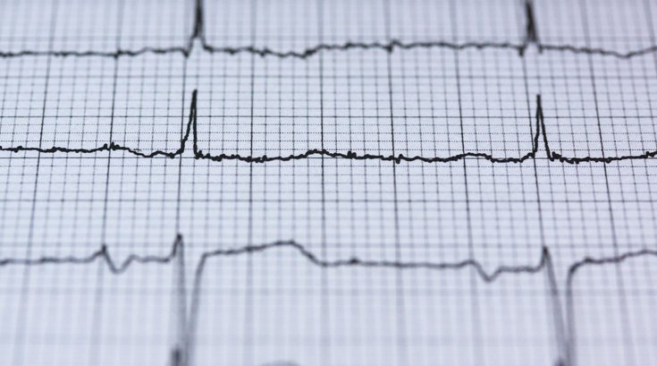 Heart Failure EKG