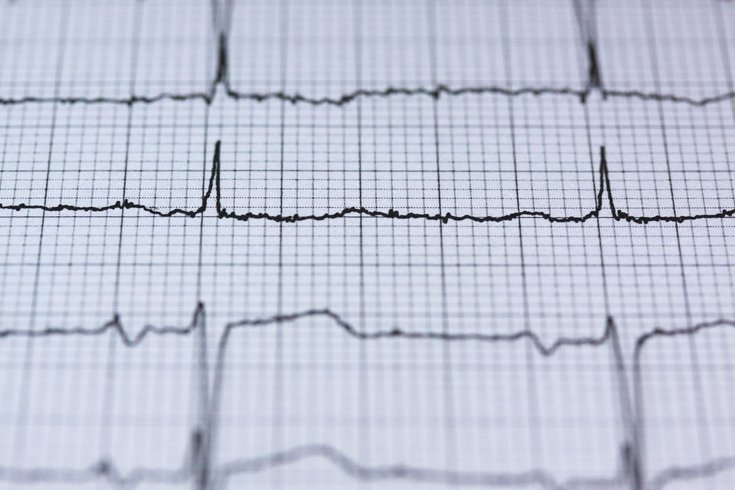 Heart Failure EKG