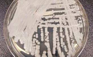 Superbugs Antimicrobial Resistance