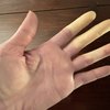 Raynaud's Syndrome