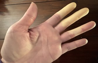 Raynaud's Syndrome