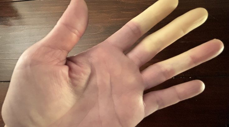 Raynaud's Syndrome