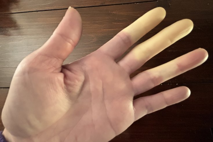 Raynaud's Syndrome