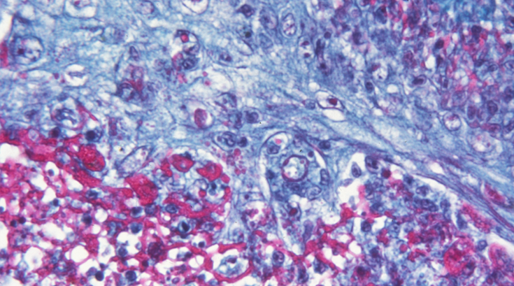 Smallpox Virus Philly