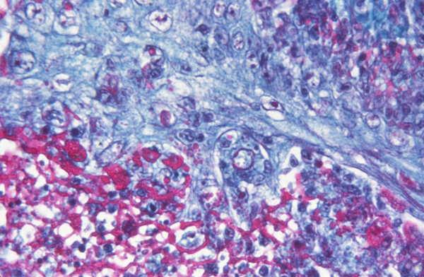 Smallpox