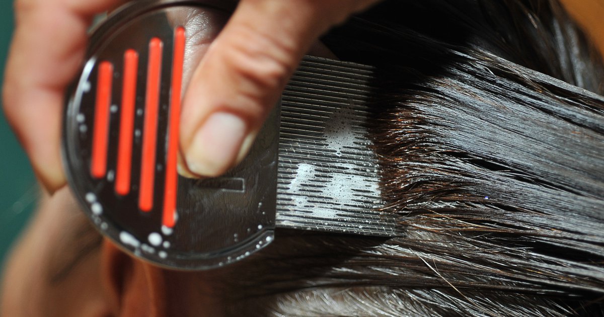 A COVID head-scratcher: Why lice lurk despite physical distancing - Vimarsana News