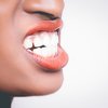 Teeth Grinding Bruxism
