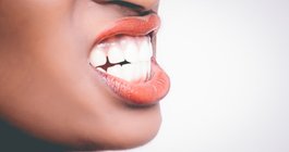 Teeth Grinding Bruxism