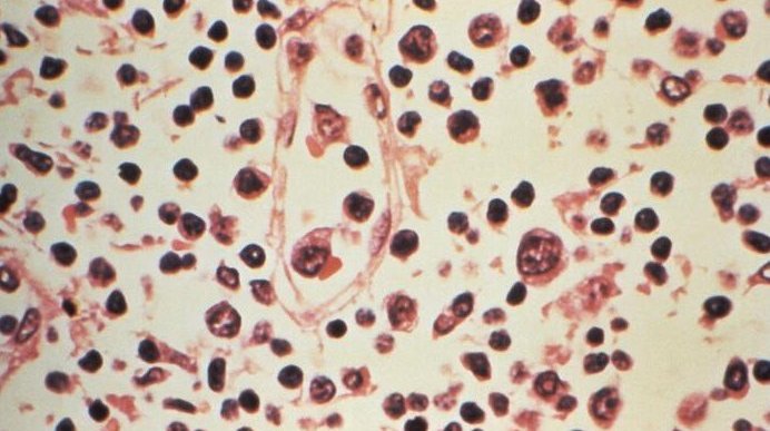 Hantavirus Update CDC