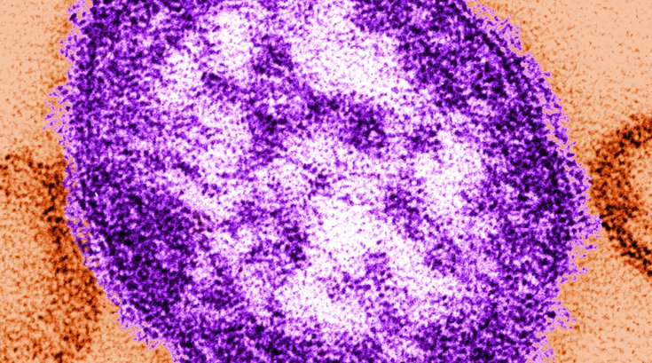 Measles