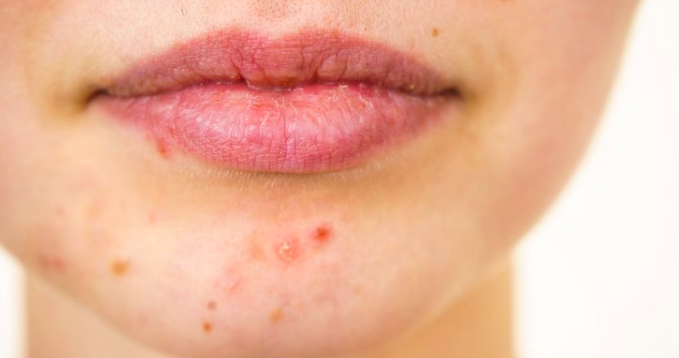 Racial disparity evident in acne treatment, according to Penn ...