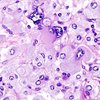 Pheochromocytoma_cancer