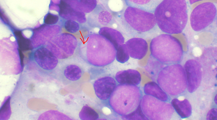 Acute myeloid leukemia