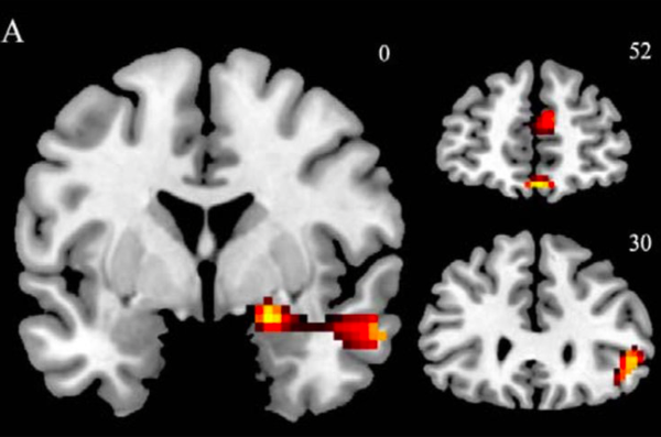 Brain scans depression