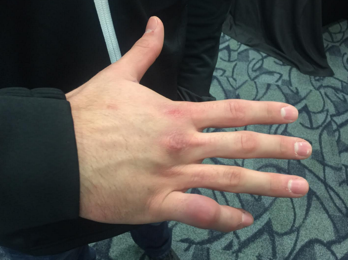 Nine players at the Senior Bowl have deformed right pinky fingers: I ...
