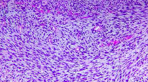 122016_Fibrosarcoma