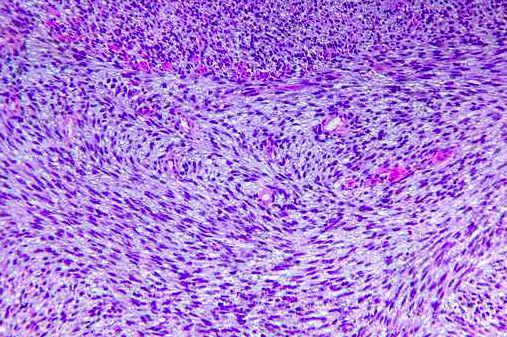 122016_Fibrosarcoma