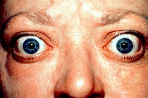 Graves' Eye Disease