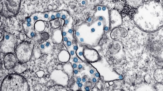 Happy hypoxia COVID-19