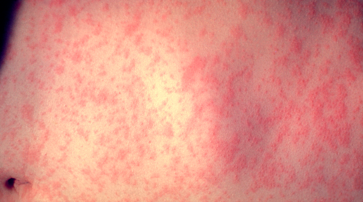 Measles rash