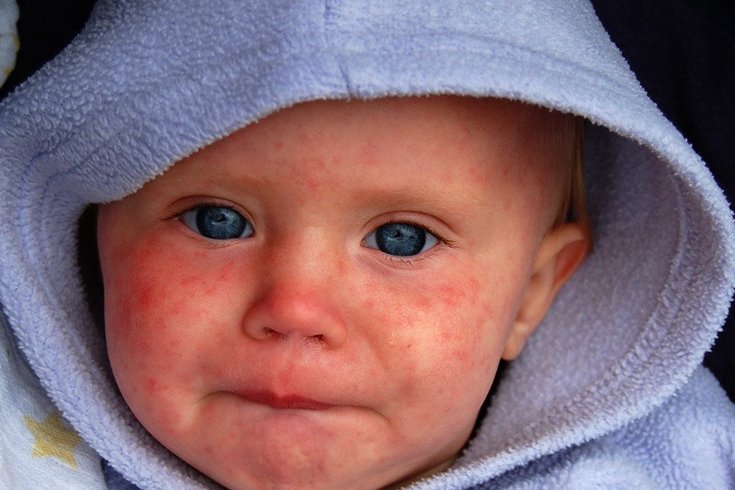 Measles vaccine babies
