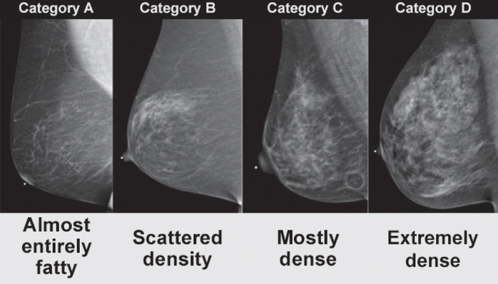 Do you know what it means to have dense breasts?