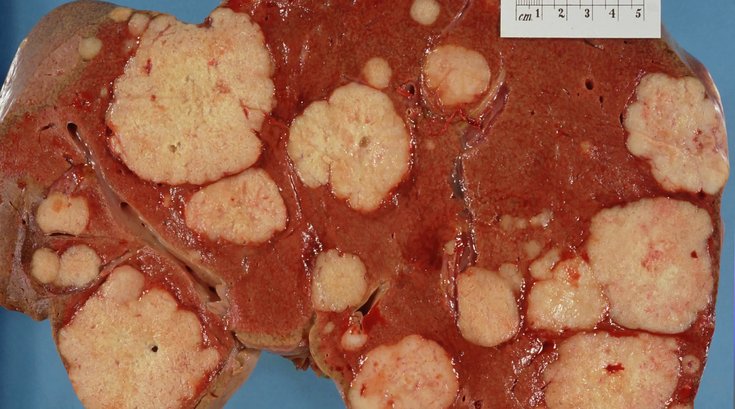 Metastatic_Cancer_Liver