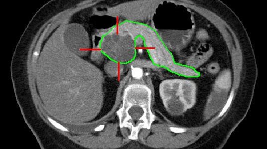 Pancreatic Cancer CT scan 