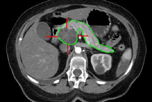 Pancreatic Cancer CT scan 