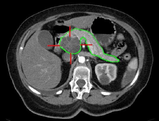 Pancreatic Cancer CT scan 
